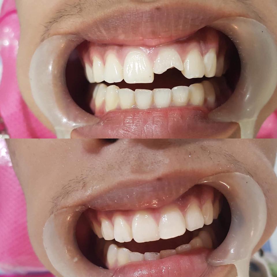 Cebu Business Directory - Fractured Central Incisor