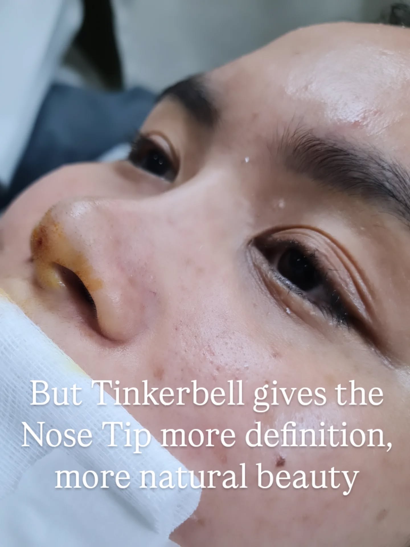 Cebu Business Directory - Nose surgery