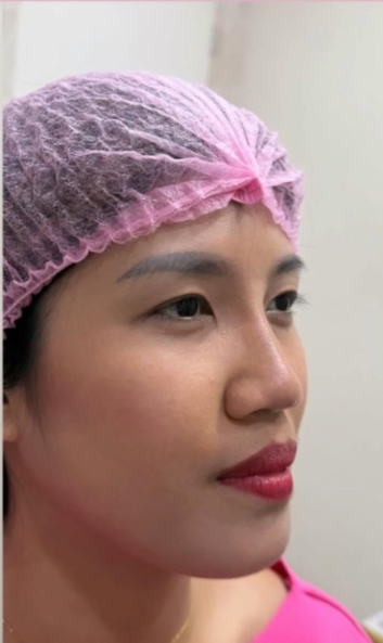 Cebu Business Directory - Non-Surgical Nose Lift - After