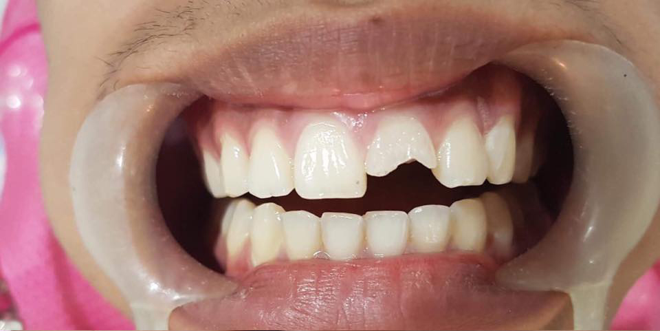 Cebu Business Directory - Fractured Central Incisor - Before