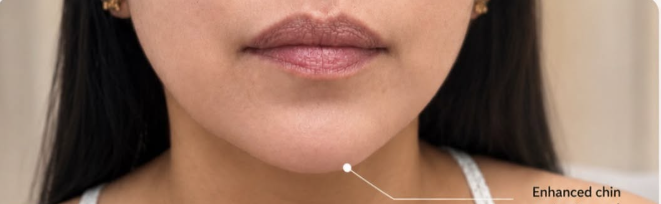 Cebu Business Directory - Chin Augmentation - After