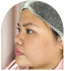 Cebu Business Directory - Nose Thread Lift - Before