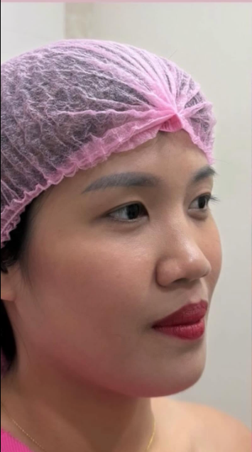 Cebu Business Directory - Non-Surgical Nose Lift - Before