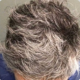 Cebu Business Directory - Hair Loss Treatment - After