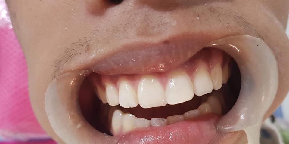 Cebu Business Directory - Fractured Central Incisor - After