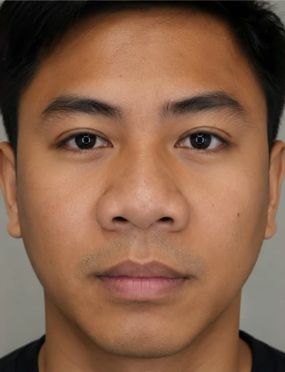 Cebu Business Directory - Nose Reduction - Before