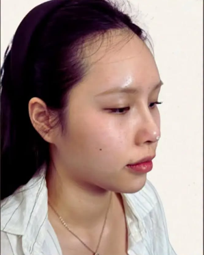 Cebu Business Directory - Hybrid Rhinoplasty - After
