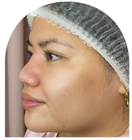 Cebu Business Directory - Nose Thread Lift - After