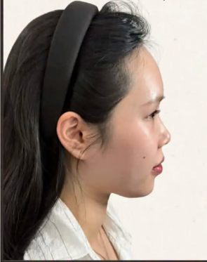 Cebu Business Directory - Hybrid Rhinoplasty - Before