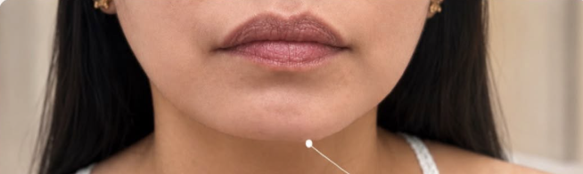 Cebu Business Directory - Chin Augmentation - Before