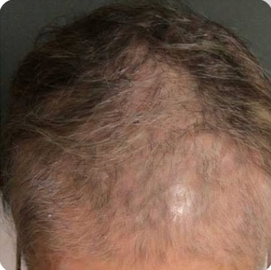Cebu Business Directory - Hair Loss Treatment - Before