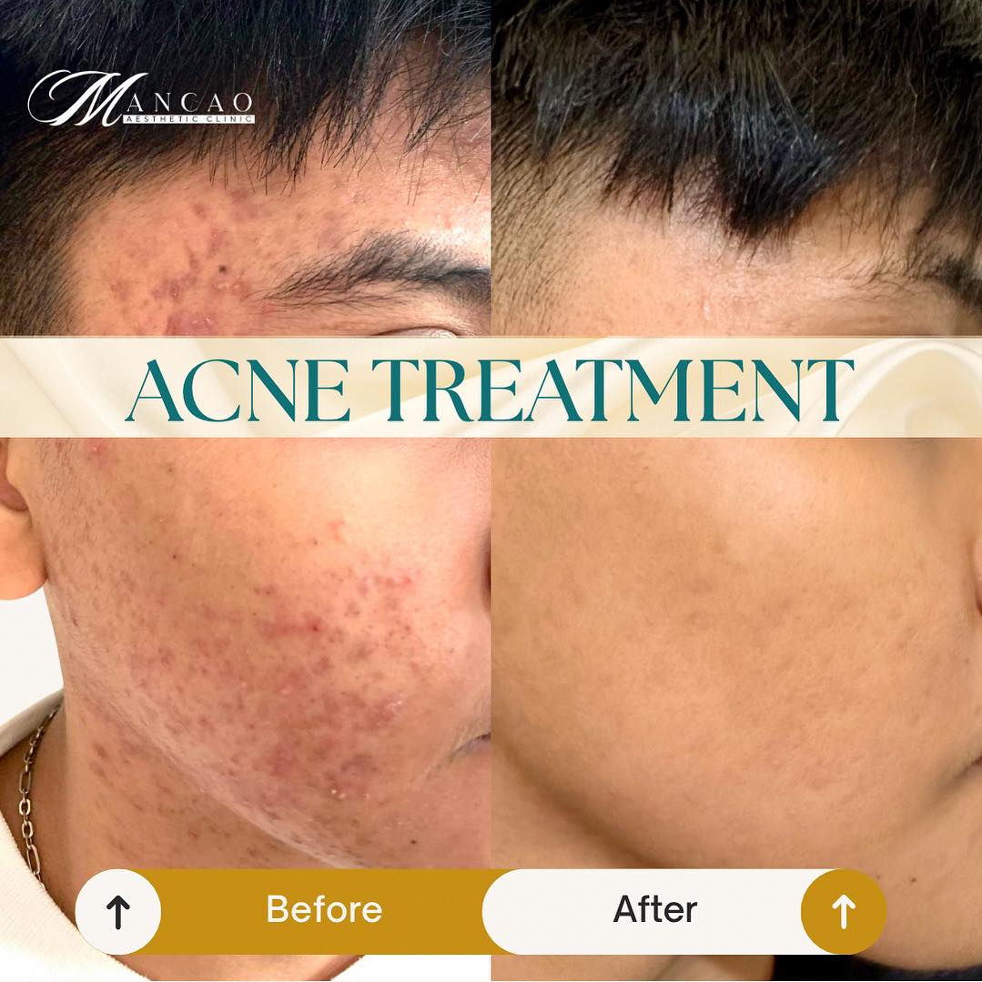 Cebu Business Directory - Acne Treatment