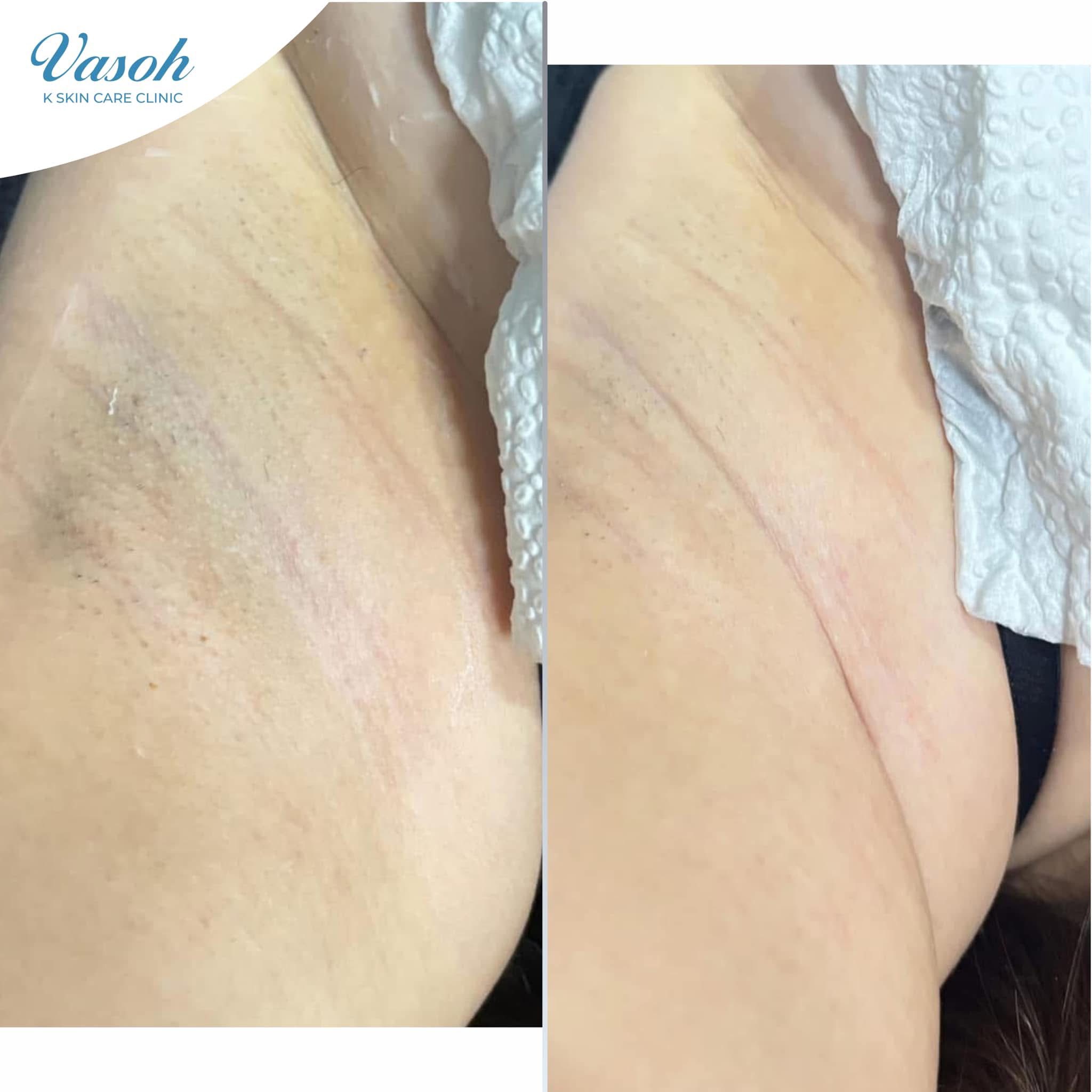 Cebu Business Directory - Underarm Whitening