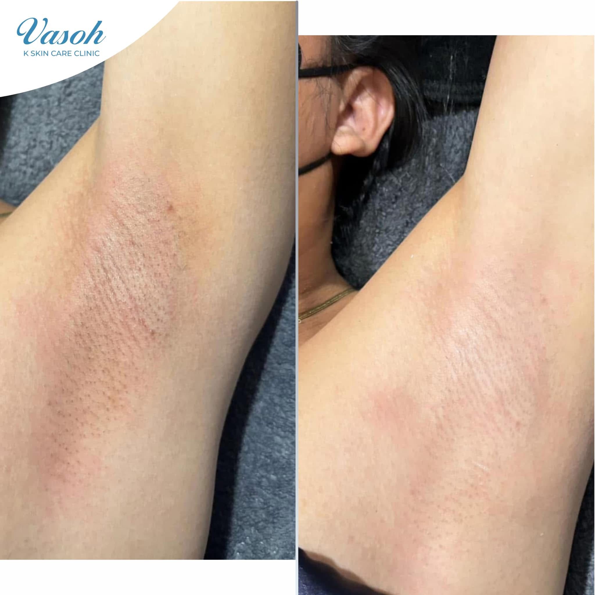 Cebu Business Directory - Underarm Whitening