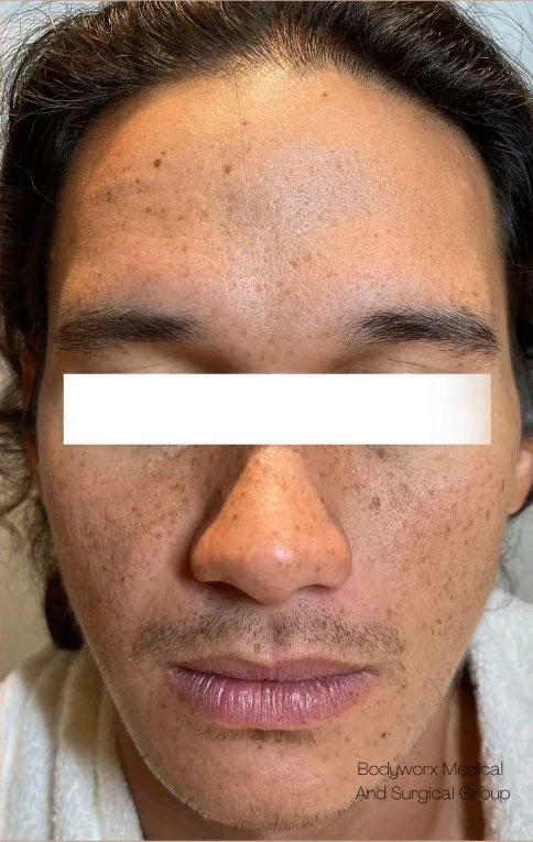 Cebu Business Directory - Oxygen Bright Facial & Botulinum Toxin Injection - After