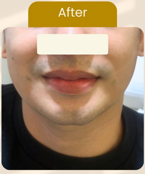 Cebu Business Directory - Chin Filler Plus Jawtox Combination - After