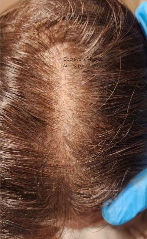 Cebu Business Directory - Hair Restoration PRP plus PRF Treatment - Before