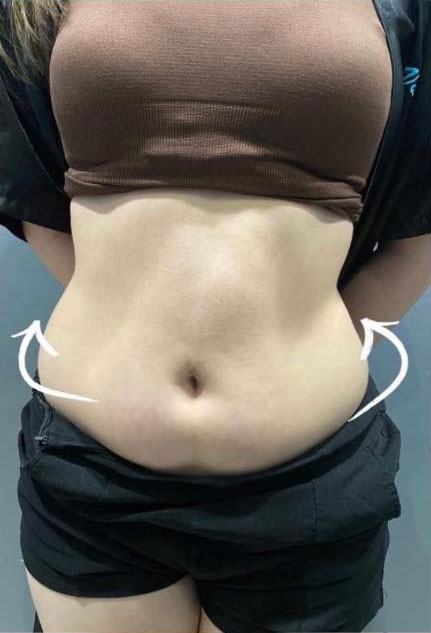 Cebu Business Directory - Emslim + Meso RF and Cavi Tummy - After