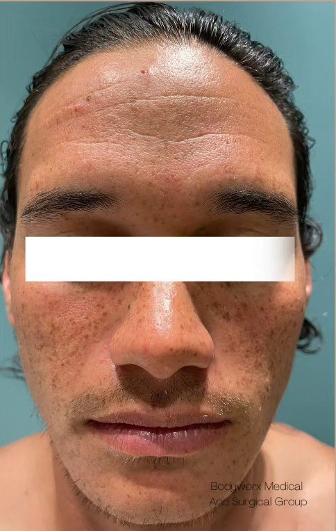 Cebu Business Directory - Oxygen Bright Facial & Botulinum Toxin Injection - Before