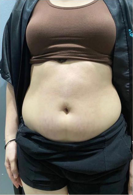 Cebu Business Directory - Emslim + Meso RF and Cavi Tummy - Before