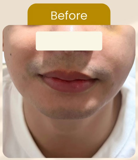 Cebu Business Directory - Chin Filler Plus Jawtox Combination - Before