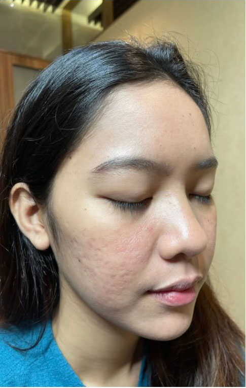 Cebu Business Directory - BMG Acne Therapy - After