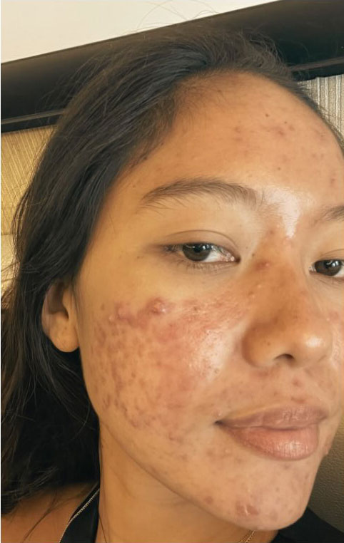 Cebu Business Directory - BMG Acne Therapy - Before