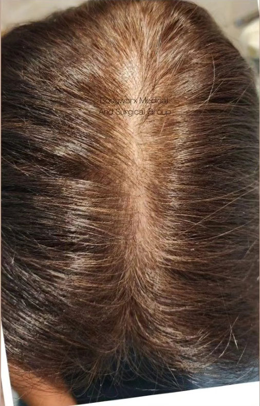 Cebu Business Directory - Hair Restoration PRP plus PRF Treatment - After