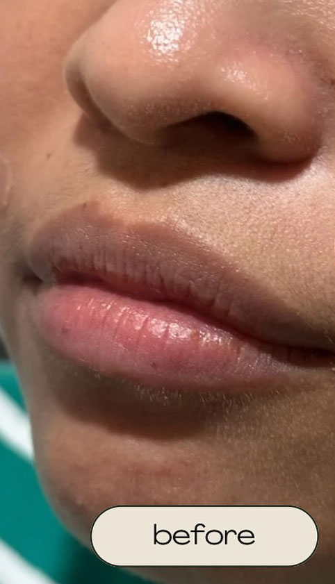 Cebu Business Directory - Lip Filler - Before