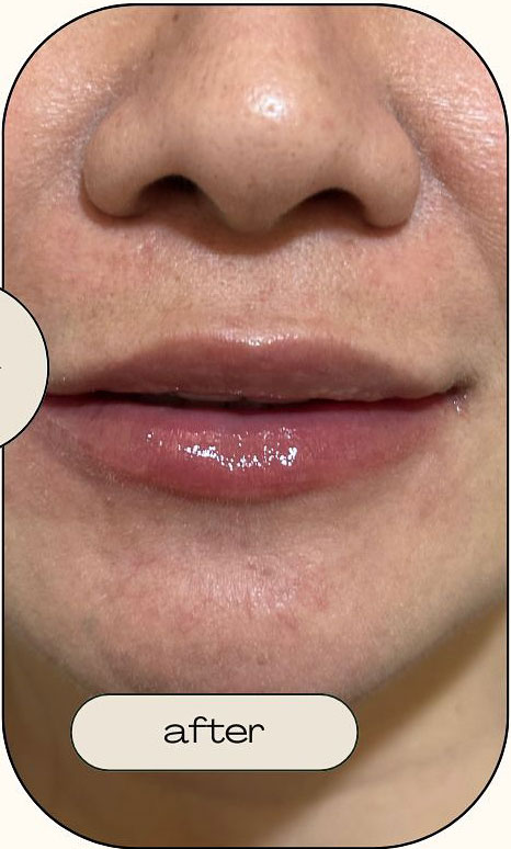 Cebu Business Directory - Lip Filler - After