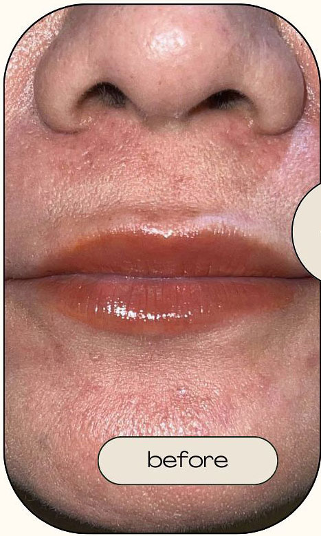 Cebu Business Directory - Lip Filler - Before