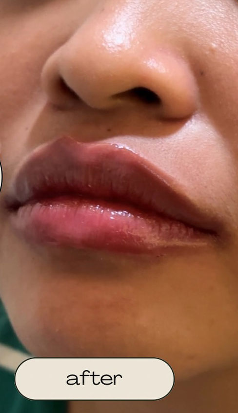Cebu Business Directory - Lip Filler - After
